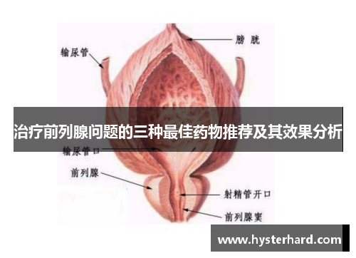 治疗前列腺问题的三种最佳药物推荐及其效果分析